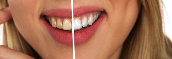 Mitos e verdades sobre clareamento nos dentes !